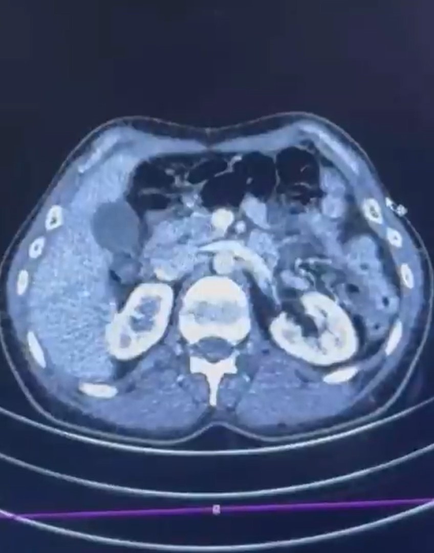 Ülkeye midelerinde uyuşturucu getiren şahıslar yakalandı